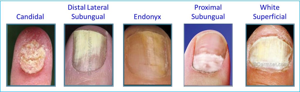 Common Fungal Nail