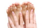 Fungal Nail Infection Lunula Laser Treatment